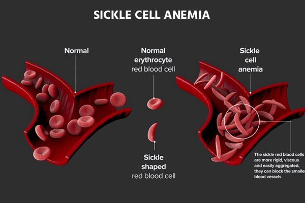 What is Sickle cell anemia?