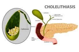 What is Cholelithiasis?