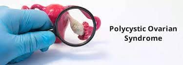 Polycystic Ovary Syndrome