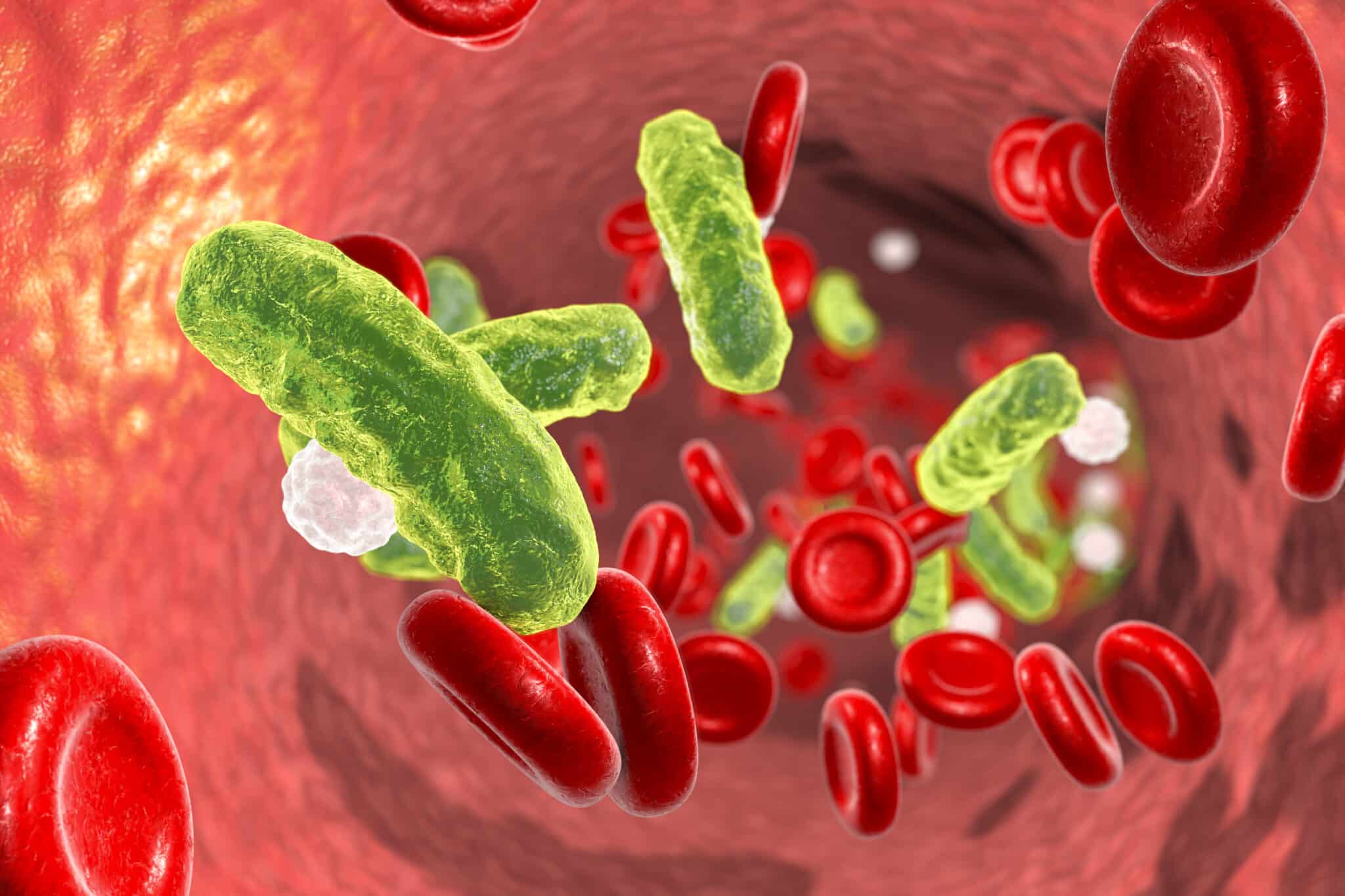 What is Sepsis?