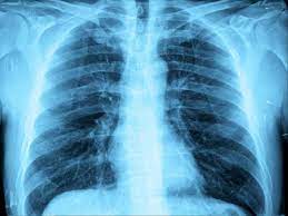 What is white lung syndrome?