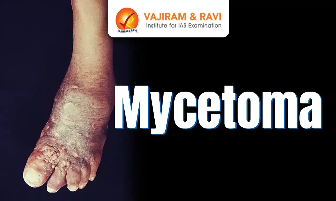 Mycetoma