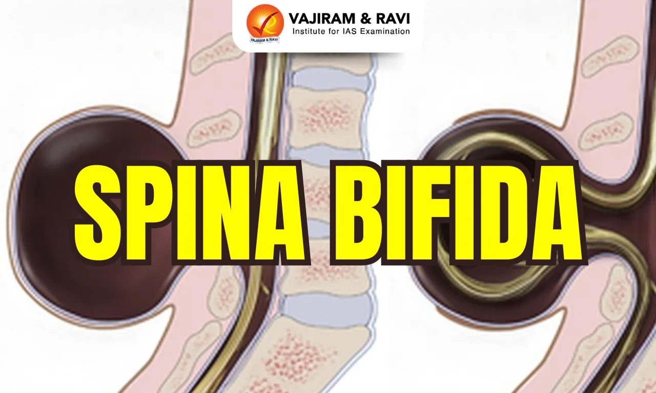 Spina Bifida