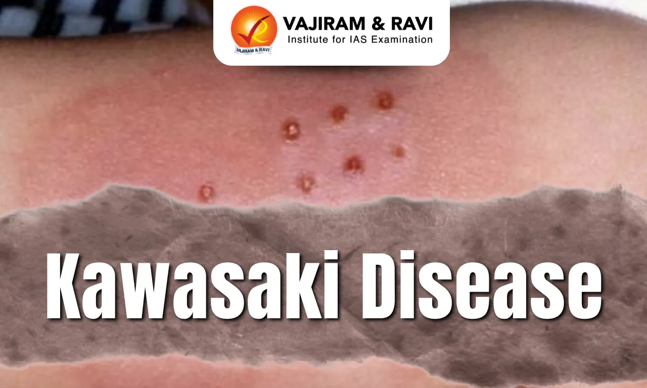 Kawasaki Disease