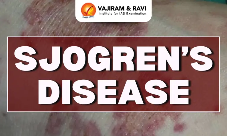 Sjogren’s Disease