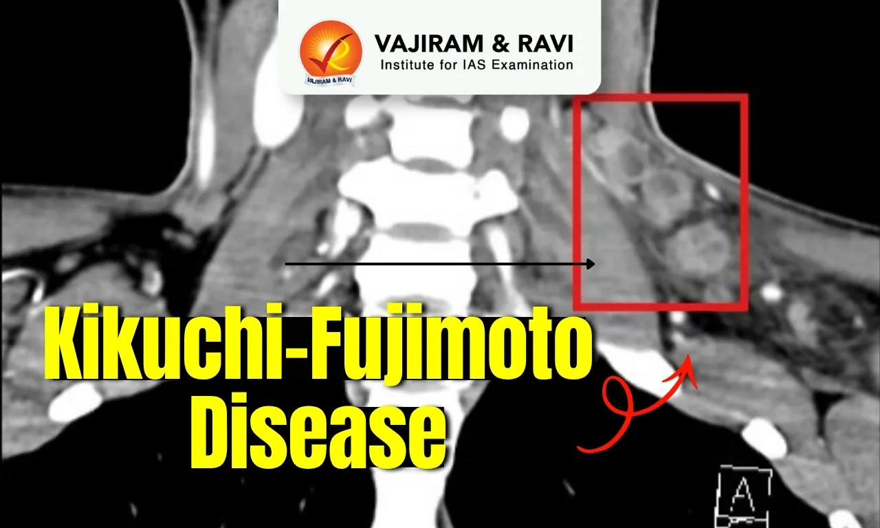 Kikuchi-Fujimoto Disease