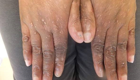 epidermolysis bullosa