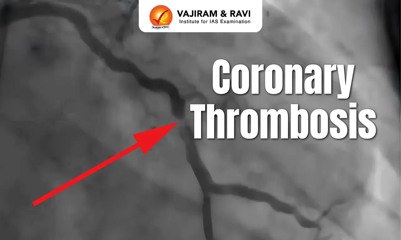 Coronary Thrombosis